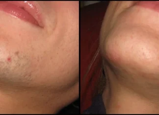 ZNATE LI ZAŠTO SE KOD ŽENA JAVLJAJU DLAKE NA BRADI? Ovako vas organizam upozorava