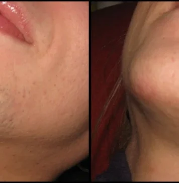 ZNATE LI ZAŠTO SE KOD ŽENA JAVLJAJU DLAKE NA BRADI? Ovako vas organizam upozorava