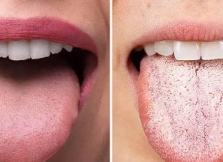 ODMAH POGLEDAJTE DA LI I VI IMATE OVO NA JEZIKU: To je znak da vam se dešavaju ove dvije stvari, PRVA VAM SE NIKAKO NEĆE DOPASTI