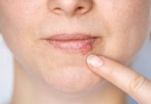 Kada herpes prestaje biti zarazan? Evo što trebate znati