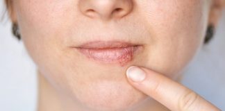 Kada herpes prestaje biti zarazan? Evo što trebate znati