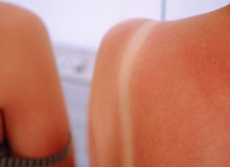 Najjednostavnija caka koja pomaže kod opekotina od sunca: Namažite ovu biljku i zaboravićete na bol i crvenilo!!!!