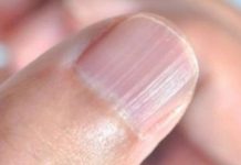 IMATE LI OVAKVE IZBOČINE NA NOKTIMA – evo šta one znače: Doktorica otkrila i možda ćete se iznenaditi IMATE LI OVAKVE IZBOČINE NA NOKTIMA – evo šta one znače: Doktorica otkrila i možda ćete se iznenaditi - featured image