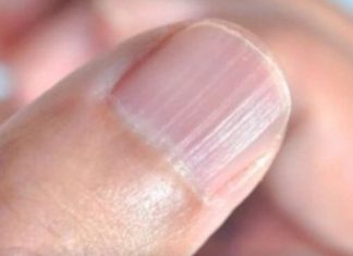 IMATE LI OVAKVE IZBOČINE NA NOKTIMA – evo šta one znače: Doktorica otkrila i možda ćete se iznenaditi IMATE LI OVAKVE IZBOČINE NA NOKTIMA – evo šta one znače: Doktorica otkrila i možda ćete se iznenaditi - featured image