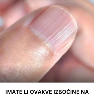 IMATE LI OVAKVE IZBOČINE NA NOKTIMA – evo šta one znače: Doktorica otkrila i možda ćete se iznenaditi IMATE LI OVAKVE IZBOČINE NA NOKTIMA – evo šta one znače: Doktorica otkrila i možda ćete se iznenaditi - featured image