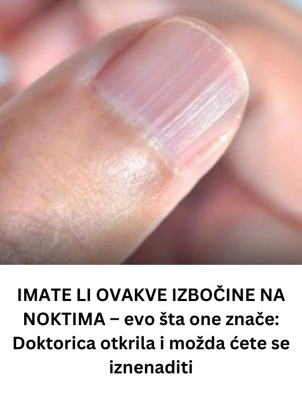 IMATE LI OVAKVE IZBOČINE NA NOKTIMA – evo šta one znače: Doktorica otkrila i možda ćete se iznenaditi - featured image IMATE LI OVAKVE IZBOČINE NA NOKTIMA – evo šta one znače: Doktorica otkrila i možda ćete se iznenaditi - featured image