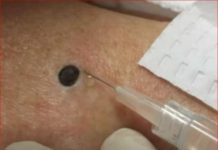 ŽENA JE GAJILA OVO NA LEĐIMA: Kada je doktorka uzela špric i bocnula, shvatit ćete zašto je SNIMAK pregledalo 33 miliona ljudi!