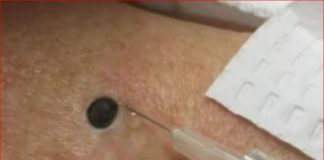ŽENA JE GAJILA OVO NA LEĐIMA: Kada je doktorka uzela špric i bocnula, shvatit ćete zašto je SNIMAK pregledalo 33 miliona ljudi!