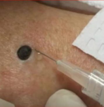 ŽENA JE GAJILA OVO NA LEĐIMA: Kada je doktorka uzela špric i bocnula, shvatit ćete zašto je SNIMAK pregledalo 33 miliona ljudi!