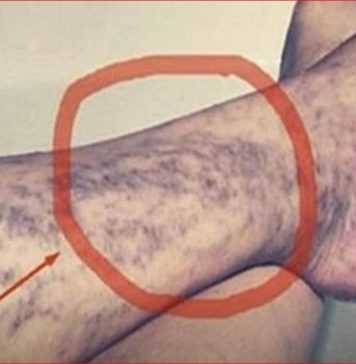 Svatko kod kuće ima lijek za popucale kapilare, ali mnogi ljudi to ne znaju! Svatko kod kuće ima lijek za popucale kapilare, ali mnogi ljudi to ne znaju! - featured image