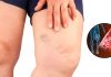 Simptomi krvnih ugrušaka u tijelu: Ako to primijetite, odmah potražite medicinsku pomoć Simptomi krvnih ugrušaka u tijelu: Ako to primijetite, odmah potražite medicinsku pomoć - featured image