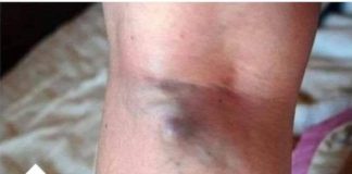 NAMIRNICE KOJE POVEĆAVAJU RIZIK OD TROMBOZE, JEDNA POSEBNO: Jedemo ih svakoga dana, a štete arterijama NAMIRNICE KOJE POVEĆAVAJU RIZIK OD TROMBOZE, JEDNA POSEBNO: Jedemo ih svakoga dana, a štete arterijama - featured image