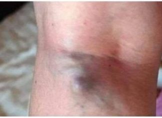 NAMIRNICE KOJE POVEĆAVAJU RIZIK OD TROMBOZE, JEDNA POSEBNO: Jedemo ih svakoga dana, a štete arterijama NAMIRNICE KOJE POVEĆAVAJU RIZIK OD TROMBOZE, JEDNA POSEBNO: Jedemo ih svakoga dana, a štete arterijama - featured image