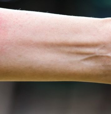 Ubod stršljena ga odveo na rub smrti,Ispovijest muškarca kojeg je napao roj stršljena ledi krv u žilama: “Srce mi je prestalo kucati, ali čudo me vratilo!